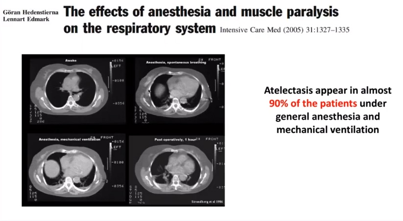 CT scans showing lung effects under anesthesia; text indicates 90% of patients face atelectasis with anesthesia.