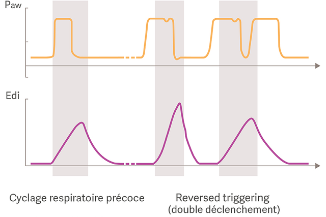 Cyclage respiratoire précoce Cyclage respiratoire précoce