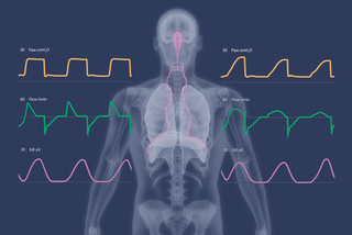 Graphic illustration showing an x-ray of a human torso with lungs, diaphragm and Edi signal as well as NAVA and NPS waveforms