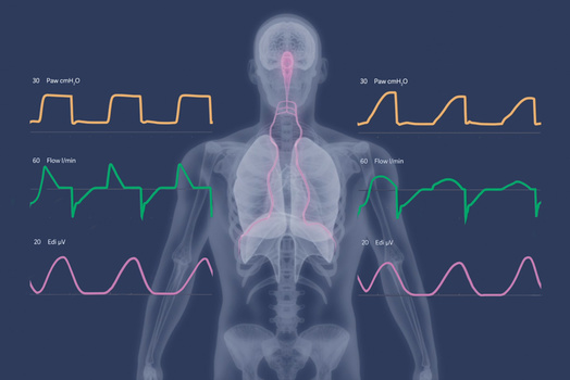 Graphic illustration showing an x-ray of a human torso with lungs, diaphragm and Edi signal as well as NAVA and NPS waveforms
