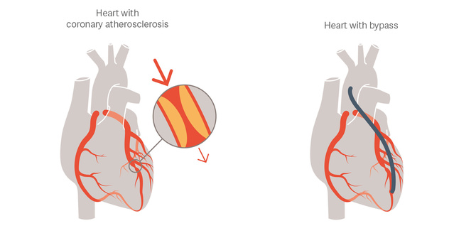 Getinge CABG illustration