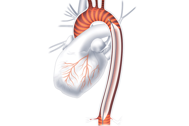 Graphic illustration of large volume balloon used in IABC procedures, Getinge 