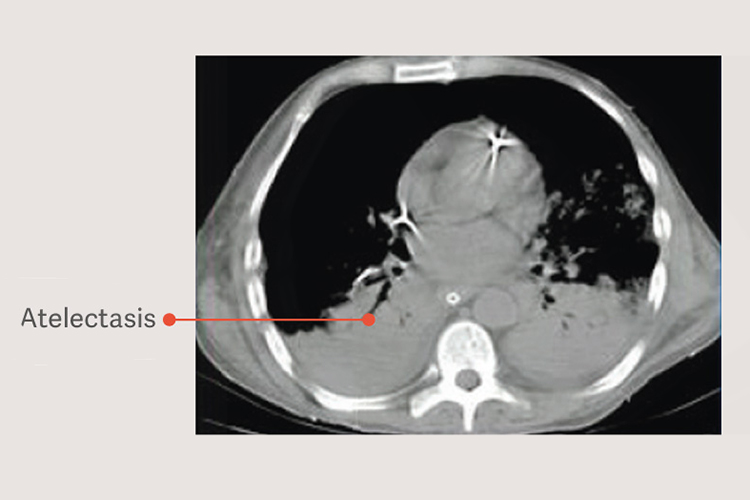 Atelectasis lung